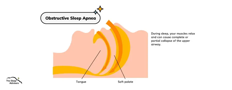 Infographic showcasing how Obstructive Sleep Apnea occurs